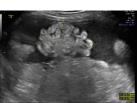 Gastroschisis free bowel